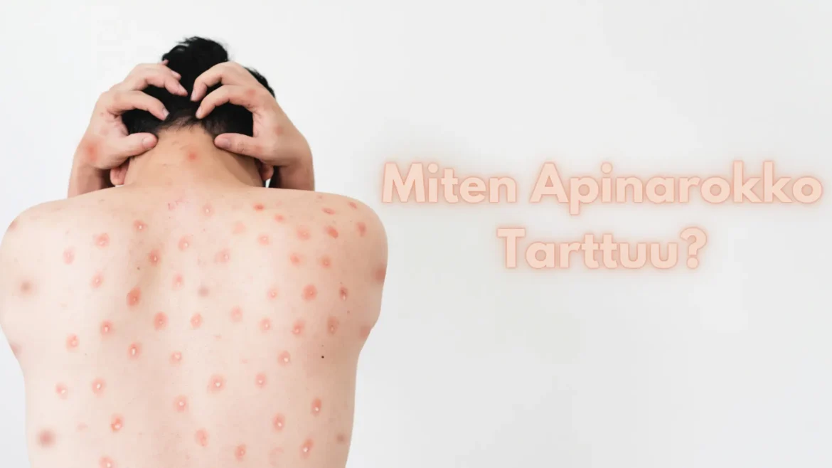 Miten Apinarokko Tarttuu Miten Apinarokko Tarttuu? – Tartuntatavat ja Ennaltaehkäisy